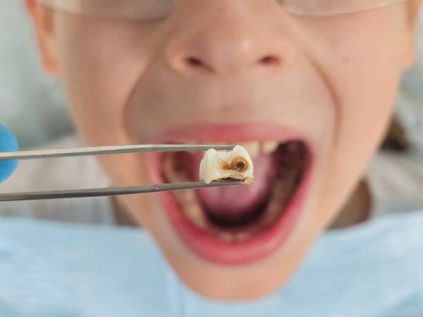 Best Emergency Dental Services for Seniors in Clarendon, TX